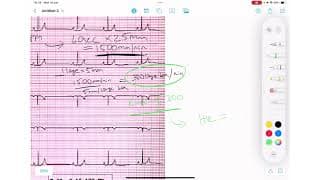 ECG Basics Series | Measurements