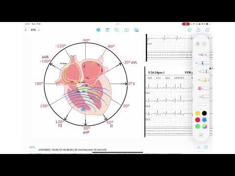 ECG Rhythm Series | Ventricular Premature Contractions