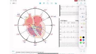 ECG Rhythm Series | Ventricular Premature Contractions
