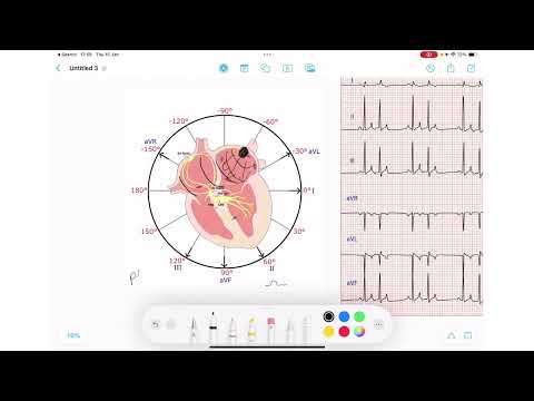 ECG Rhythm Series | Premature Atrial Contractions (PACs)