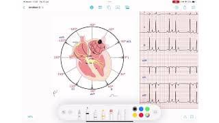 ECG Rhythm Series | Premature Atrial Contractions (PACs)
