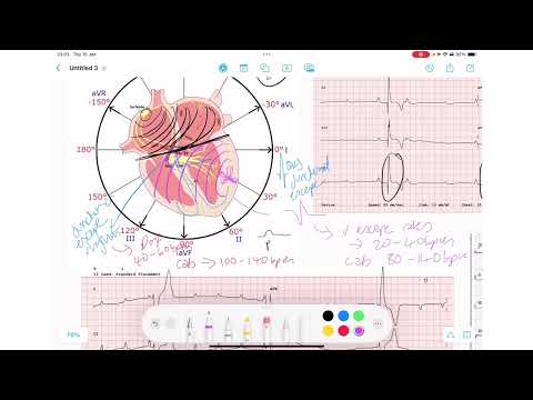 ECG Rhythm Series | Complete Heart Block
