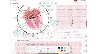ECG Rhythm Series | Complete Heart Block