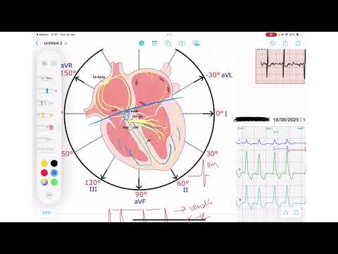 ECG Rhythm Series | Atrial Fibrillation