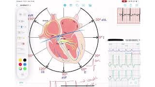 ECG Rhythm Series | Atrial Fibrillation