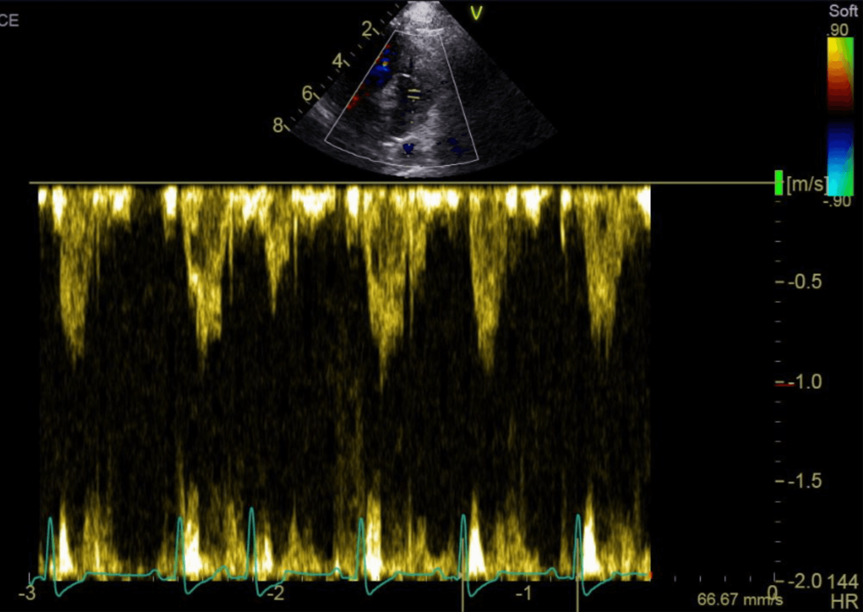 Arrhythmia in a Cavalier King Charles Spaniel with MMVD Stage B1